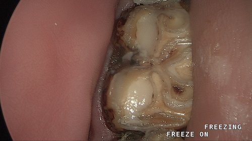 pulp capping